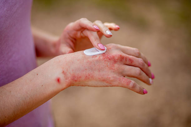 Eczema on the hands
